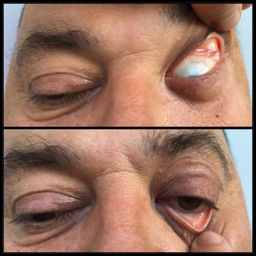 Floppy eyelid syndrome
